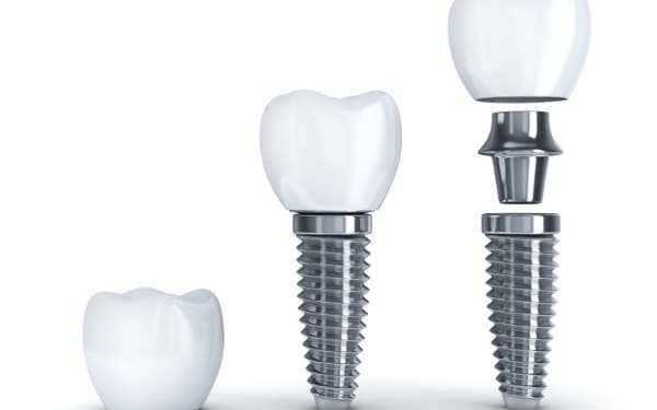 Titanium root implants